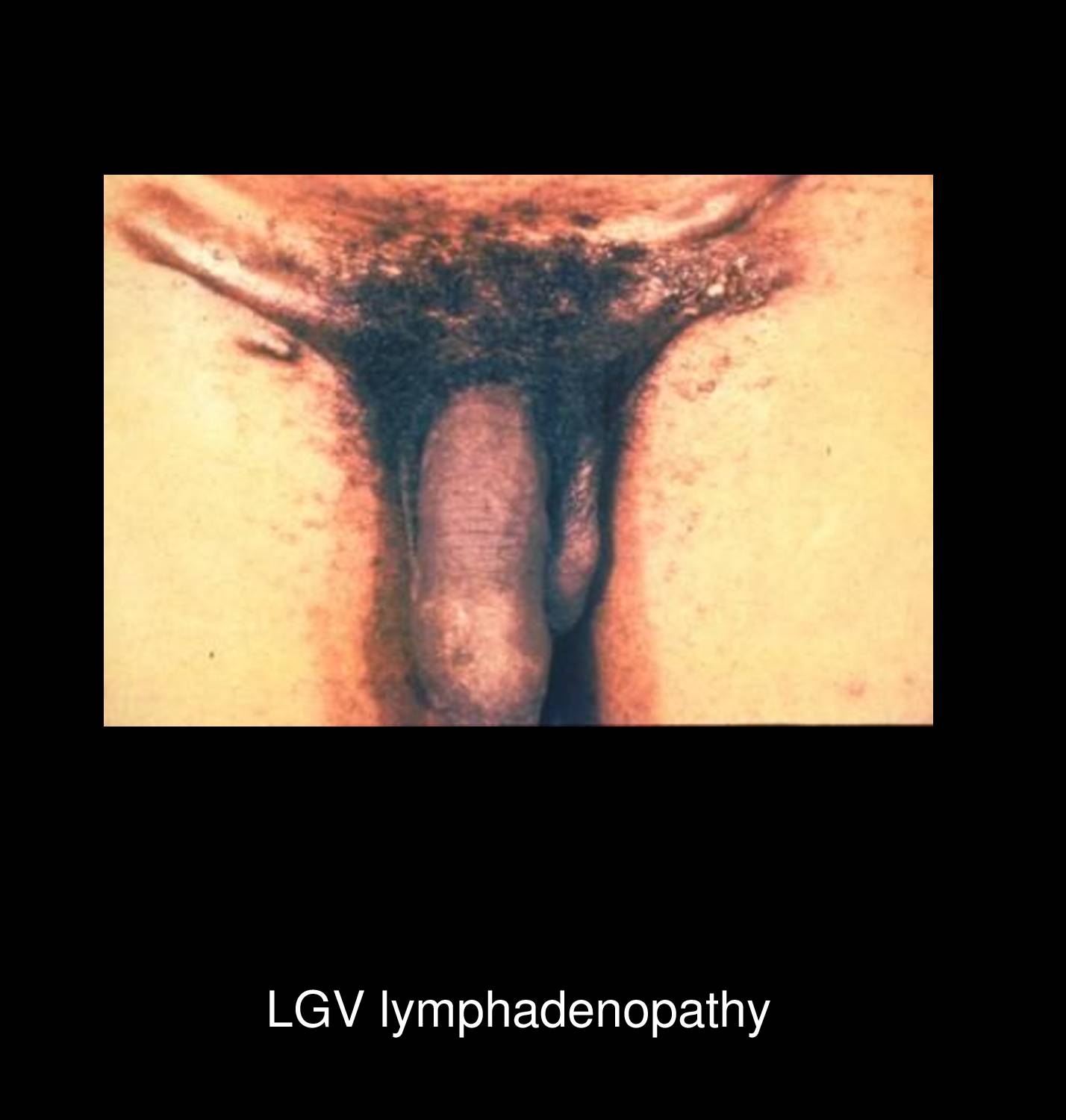 LGV primary genital ulcer showing transient painless papule on penis that precedes inguinal lymphadenopathy in Chlamydia trachomatis infection